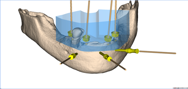 stackable-Fall mit Dr. Jan Spieckermann