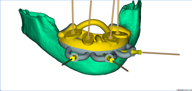 stackable-Fall mit Dr. Jan Spieckermann