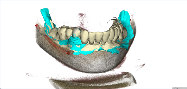stackable-Fall mit Dr. Jan Spieckermann