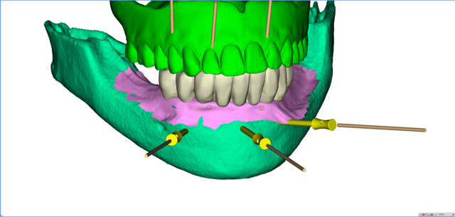 stackable-Fall mit Dr. Jan Spieckermann