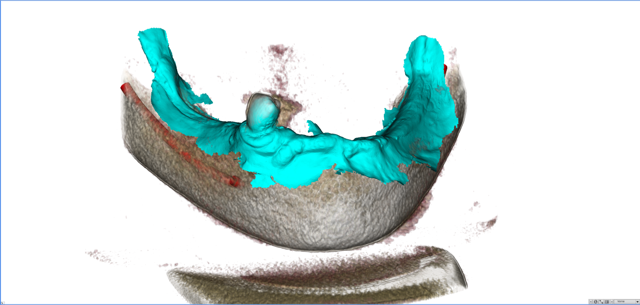 stackable-Fall mit Dr. Jan Spieckermann