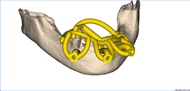 stackable-Fall mit Dr. Jan Spieckermann