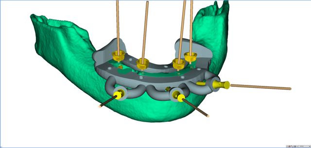 stackable-Fall mit Dr. Jan Spieckermann