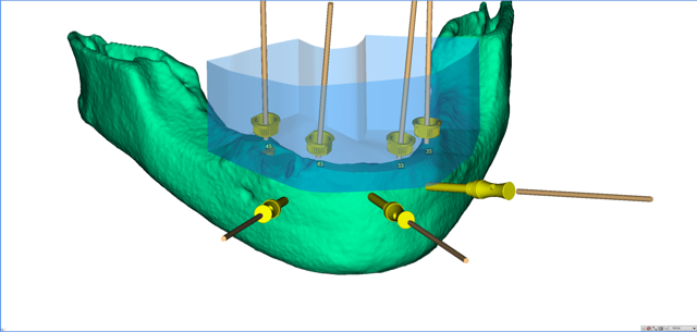 stackable-Fall mit Dr. Jan Spieckermann
