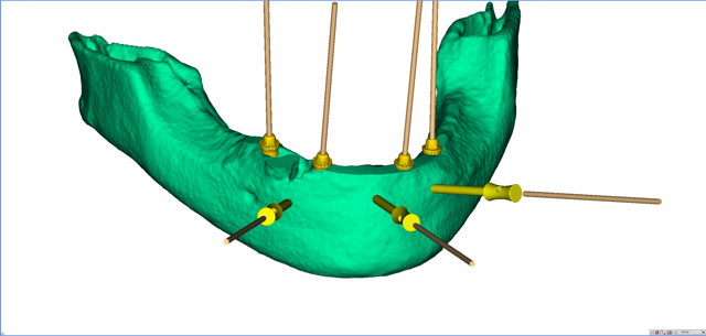 stackable-Fall mit Dr. Jan Spieckermann
