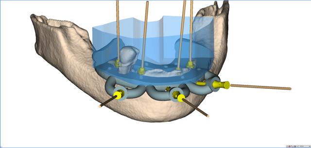 stackable-Fall mit Dr. Jan Spieckermann