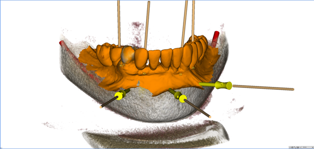 stackable-Fall mit Dr. Jan Spieckermann