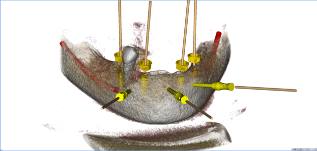 stackable-Fall mit Dr. Jan Spieckermann