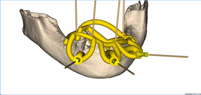 stackable-Fall mit Dr. Jan Spieckermann