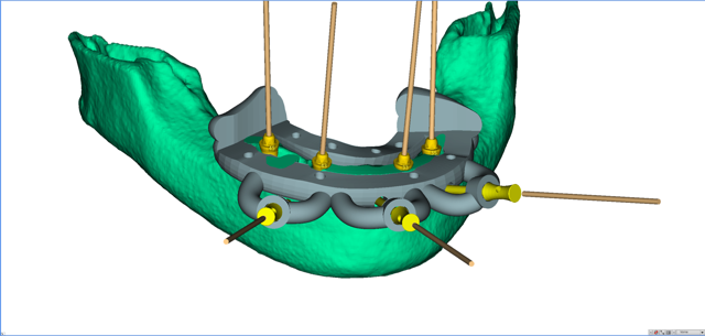 stackable-Fall mit Dr. Jan Spieckermann