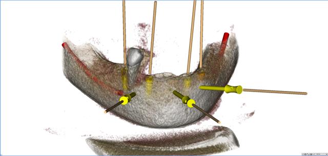 stackable-Fall mit Dr. Jan Spieckermann