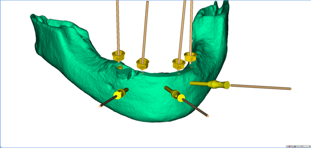 stackable-Fall mit Dr. Jan Spieckermann