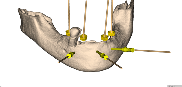 stackable-Fall mit Dr. Jan Spieckermann